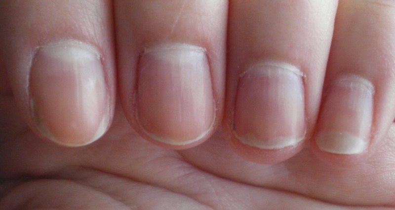3. Anemia and Pale Nail Beds - wide 2