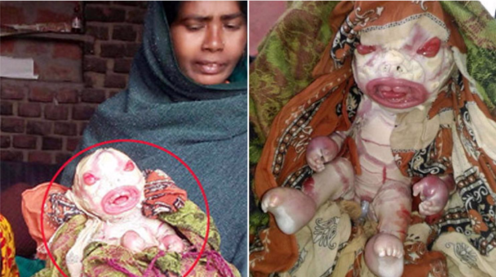 Harlequin Ichthyosis: Mother Abandons Baby With Shell-Like ...