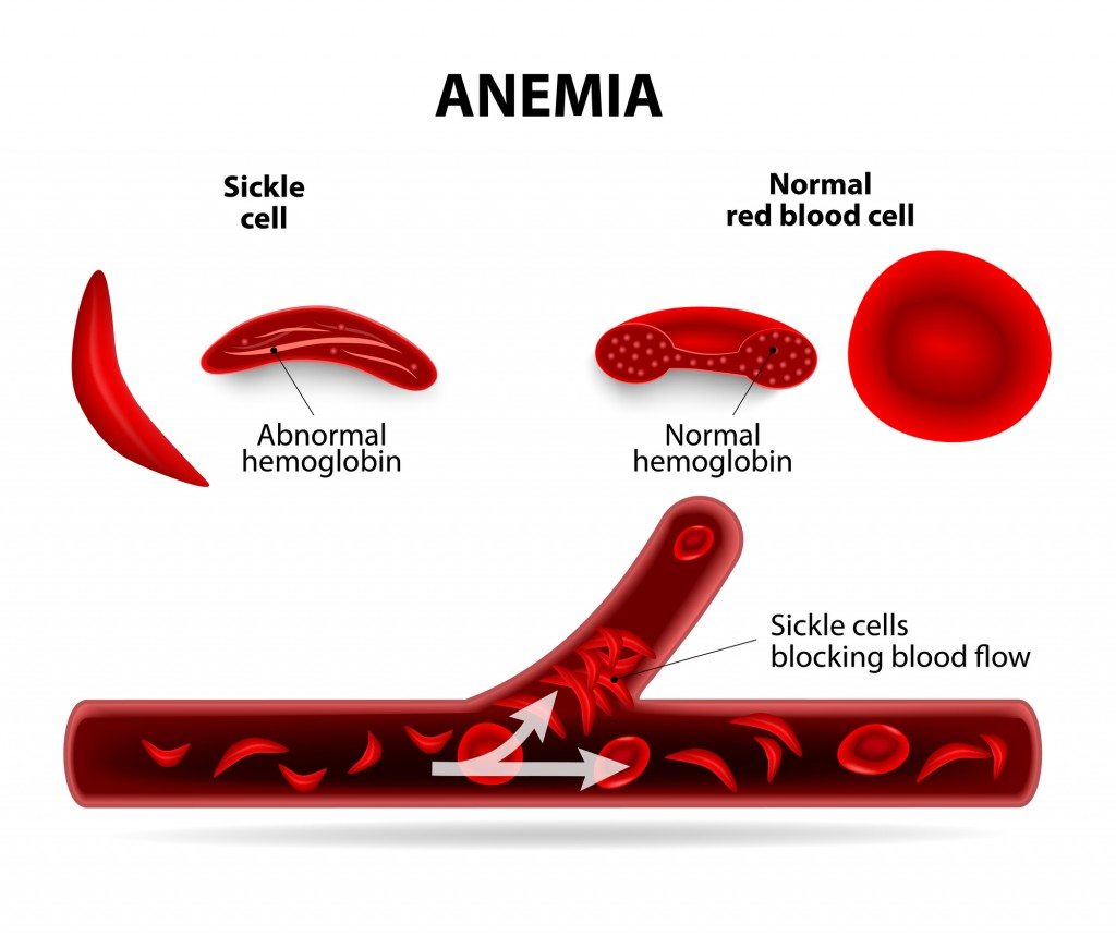 sickle cell anemia quincy me