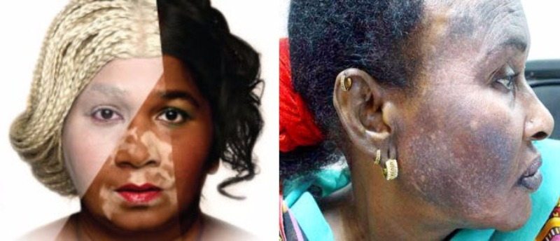 Pros and Cons of Skin Lightening, Toning and Bleaching
