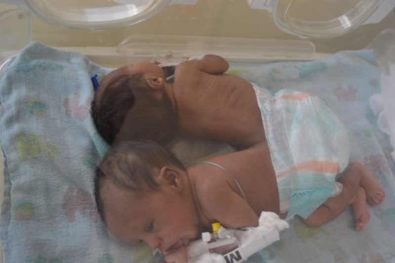 Doctors save Conjoined Twins
