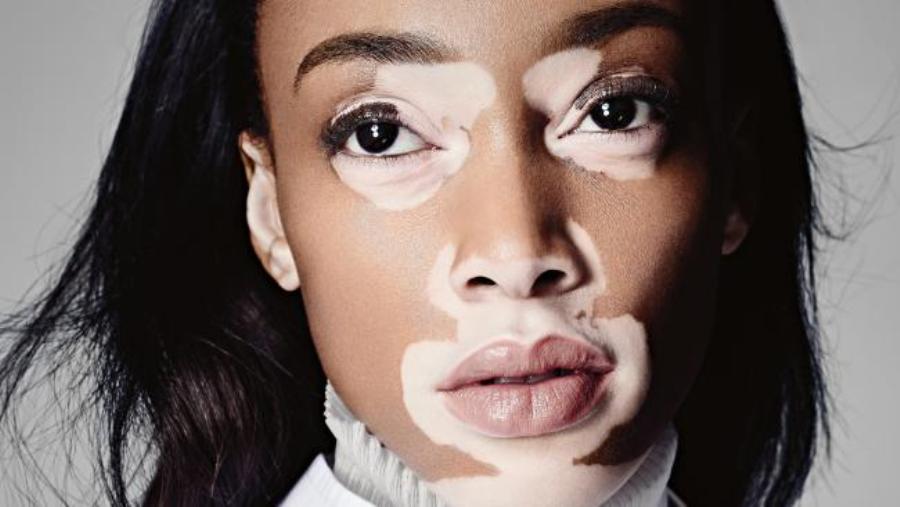 Vitiligo Skin Disease: All You Should Know About The Skin Disorder