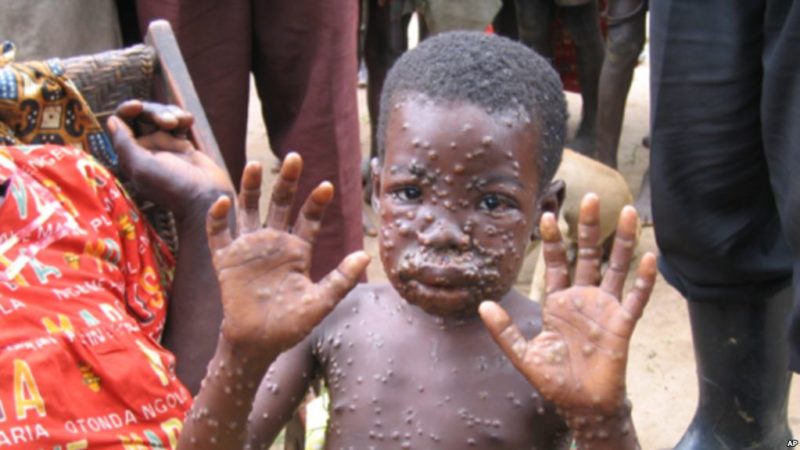 Image result for Monkeypox: 11 persons placed under surveillance in Bayelsa